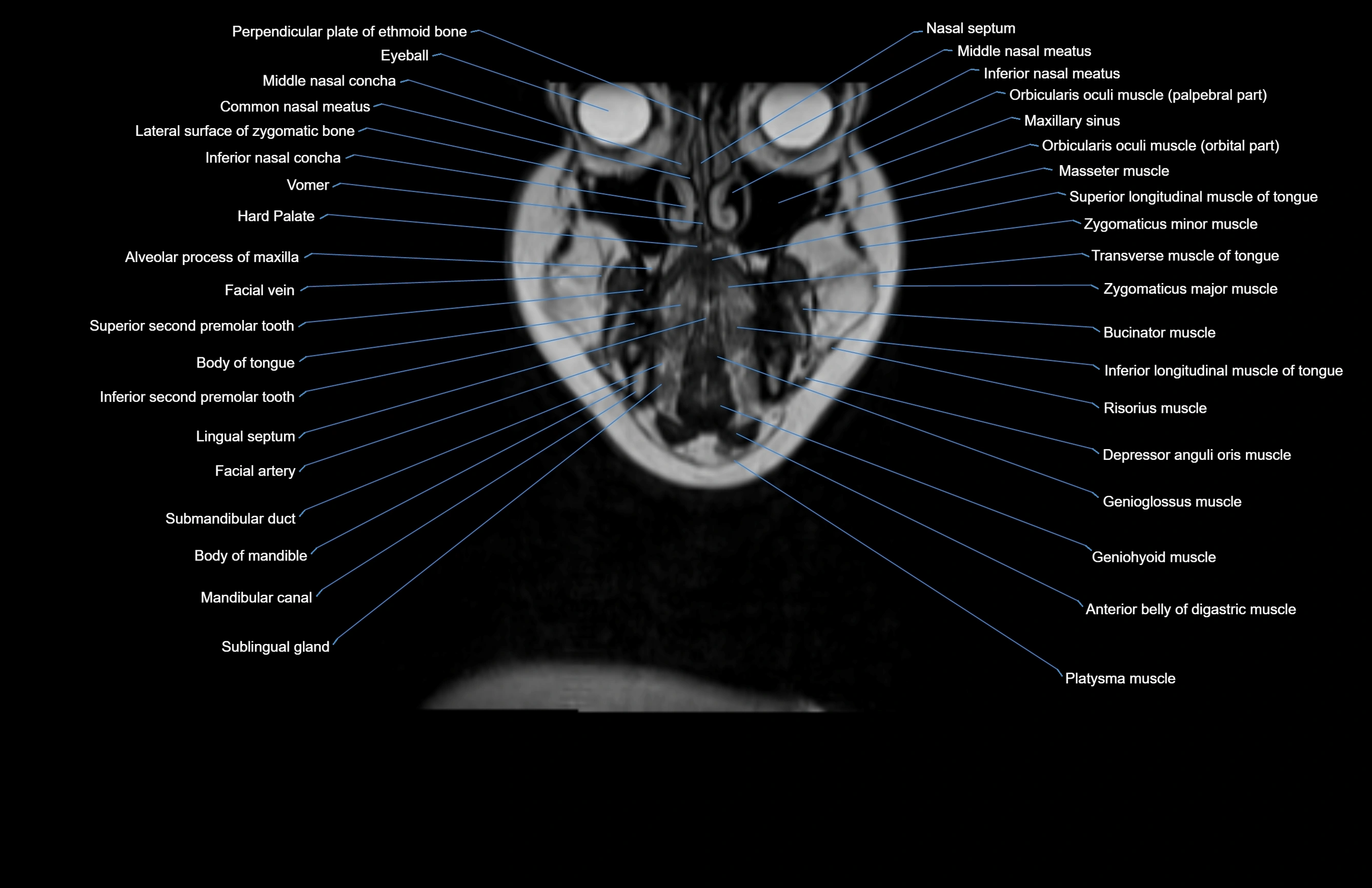 Neck coronal cross sectional MRI anatomy 3T MRI  image-img-00001-00065.webp